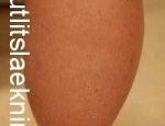 vessabjugur-lymphedema-ea-lymphoedema-300x2001-e1370869580966