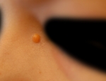 xanthogranuloma
