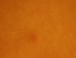 dermatofibroma4