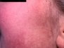 Keratosis pilaris 