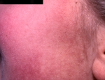 keratosis-pilaris