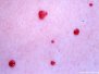 Kirsuberjaæðaæxli (cherry angioma)