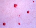 cherry-angkiomas-v