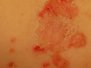Kossageit (impetigo) og blöðrukossageit (bullous impetigo) 