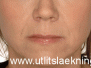 Meðferð með húðfyllingaefnum (fillers)
