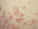 herpes-gest