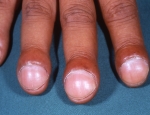 naglbreyting-sem-kallast-nail-clubbing-ensku-lknisfrilegar-stur-geta-legi-bak-vi-essa-naglbreytingu