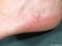 Piezogenic pedal papules
