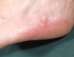 piezogenic-pedal-papules-3