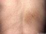 Pigmented pruritic patch