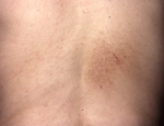 pigmented-pruritic-patch-2