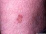 Porokeratosis