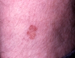 porokeratosis-5