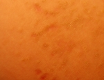 pseudoacanthosis-nigricans