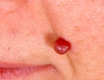 pyogen-granuloma