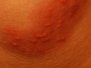 Ristill (herpes zoster)