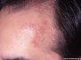 Sarklíki (Sarcoidosis)