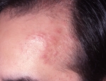 sarcoidosis-4