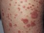 Sóri (psoriasis)
