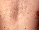 dropasri-guttate-psoriasis-me-kbners-fyrirbri-kbners-phenomen