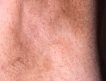 neurofibromatosis