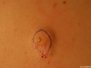 Þekjulíkisblöðrur (epidermoid cysts)