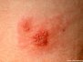 Varaáblásturssótt (herpes simplex labialis) 