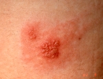 herpes-simplex-arm